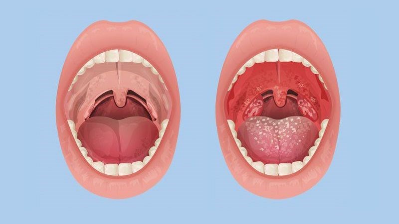Tình trạng khô họng thường gặp ở mọi lứa tuổi
