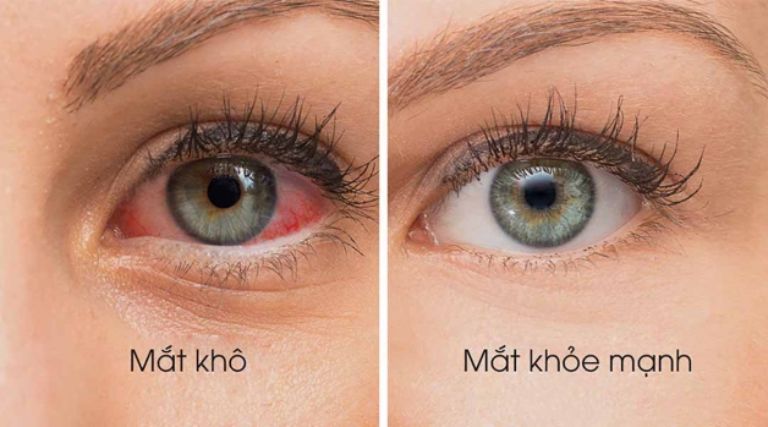 Triệu chứng khô mắt