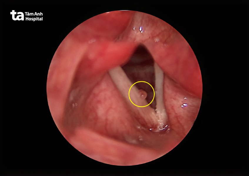 Polyp dây thanh hình thành trên bề mặt dây thanh quản