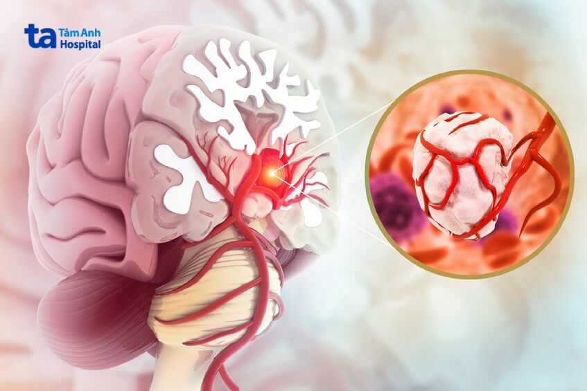 U nguyên bào thần kinh đệm
