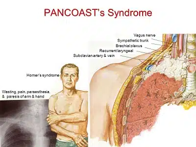 Hội chứng đỉnh phổi (U Pancoast): Nguyên nhân, triệu chứng và cách điều trị 7 Hình ảnh khối u Pancoast trên phim CT