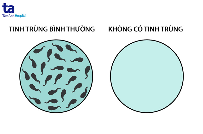 Không có tinh trùng do tắc nghẽn