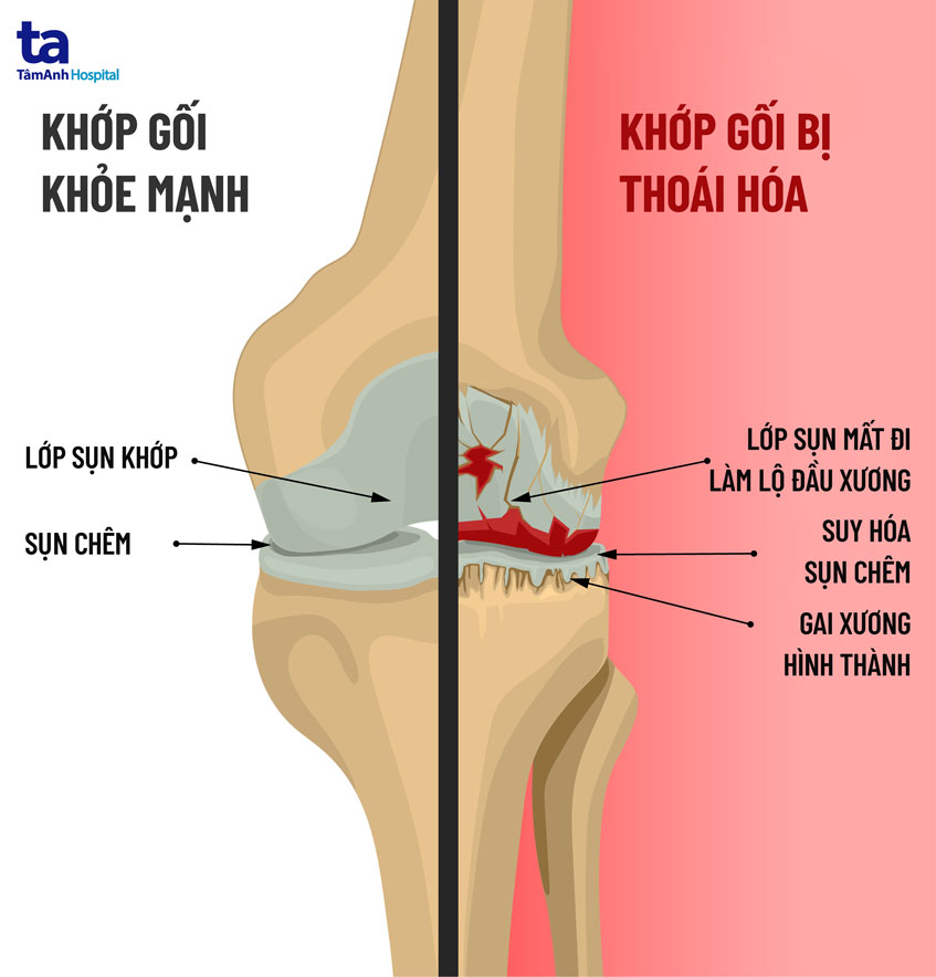 Khớp bị thoái hóa - Nguyên nhân dẫn đến gai xương