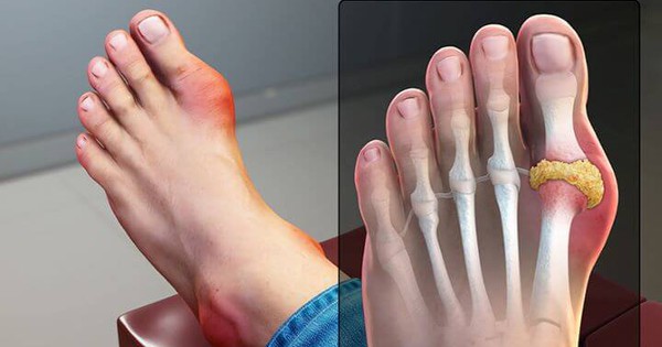 Khớp ngón chân cái bị sưng đỏ