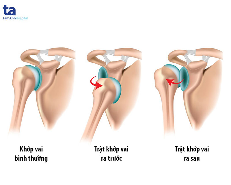 Hình ảnh khớp vai bị trật