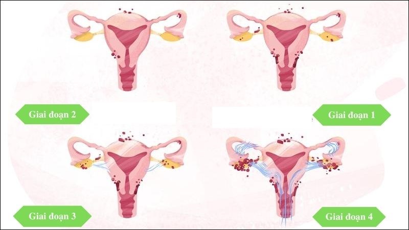 U lạc nội mạc tử cung ở buồng trứng: Nguyên nhân, triệu chứng và điều trị 7 U lạc nội mạc tử cung buồng trứng