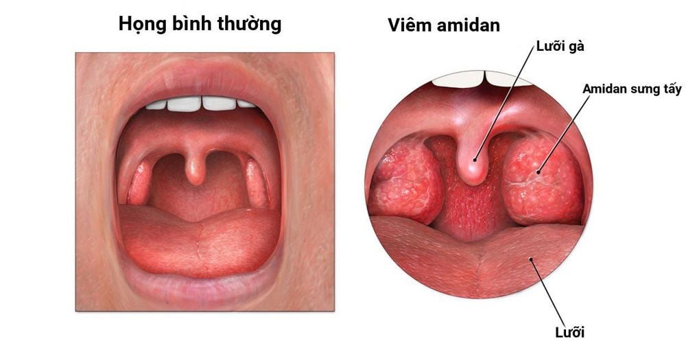 Viêm họng cấp sưng amidan