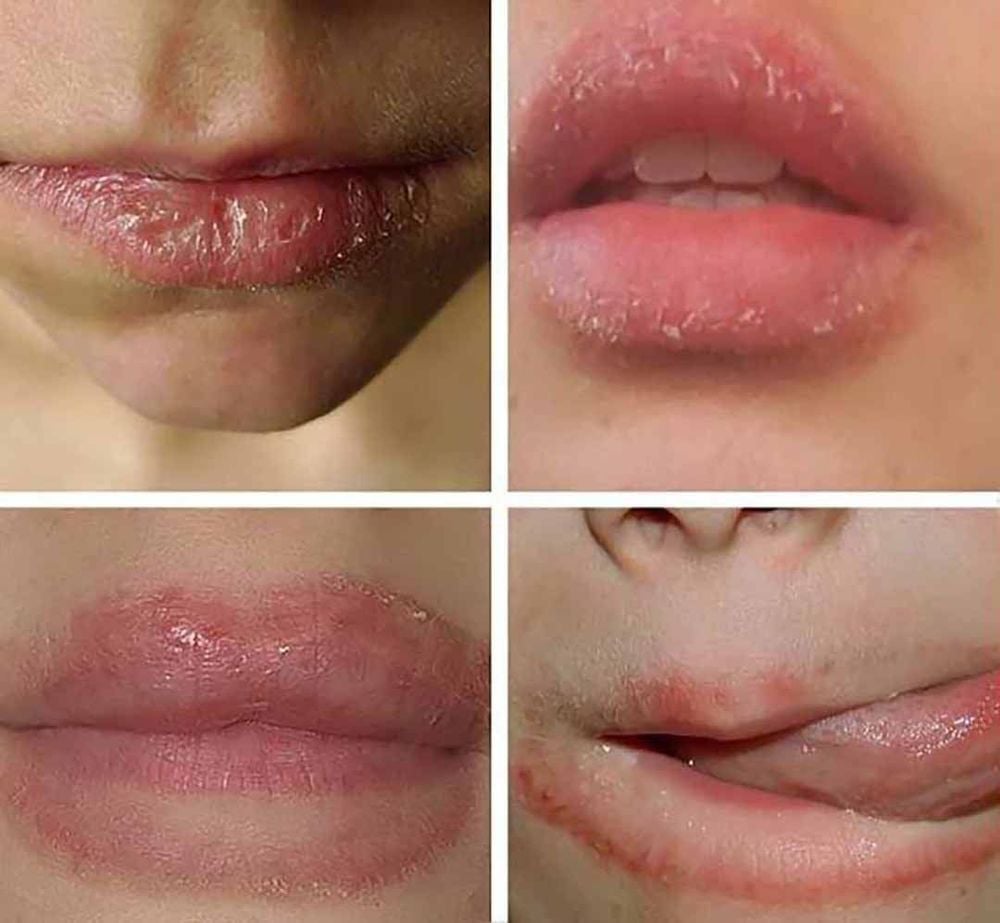 Chàm môi thể nặng