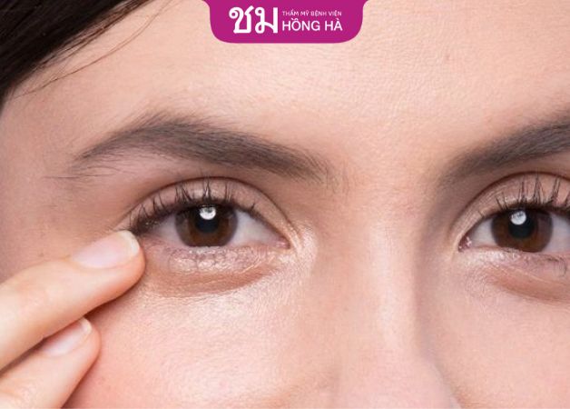 quy trình lấy mỡ bọng mắt