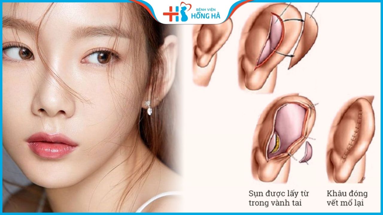Lấy sụn tai nâng mũi có đau không?