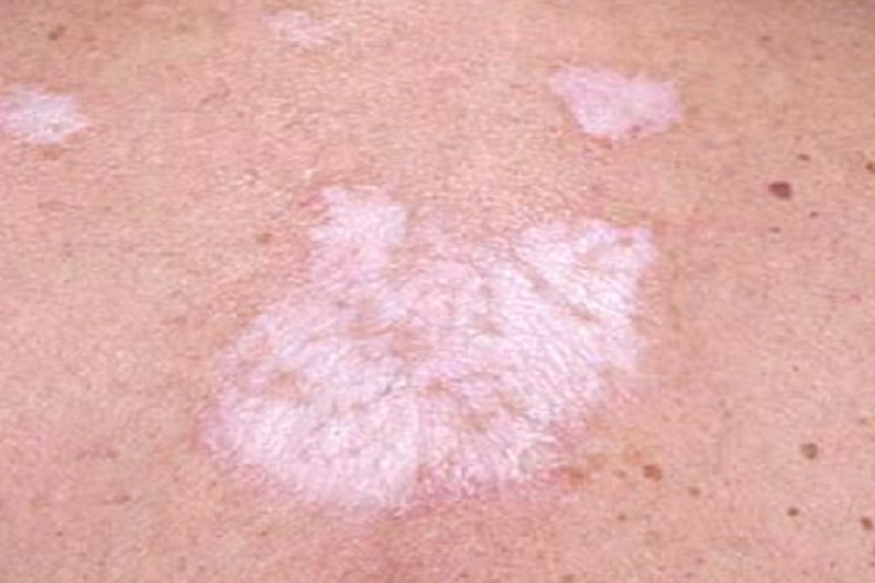 Hình ảnh tổn thương lichen xơ hóa