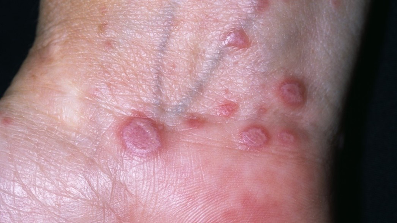 Lichen phẳng là gì? Triệu chứng, nguyên nhân và cách điều trị hiệu quả 7 Hình ảnh lichen phẳng ở da