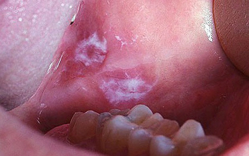 Lichen phẳng là gì? Triệu chứng, nguyên nhân và cách điều trị hiệu quả 8 Lichen phẳng miệng