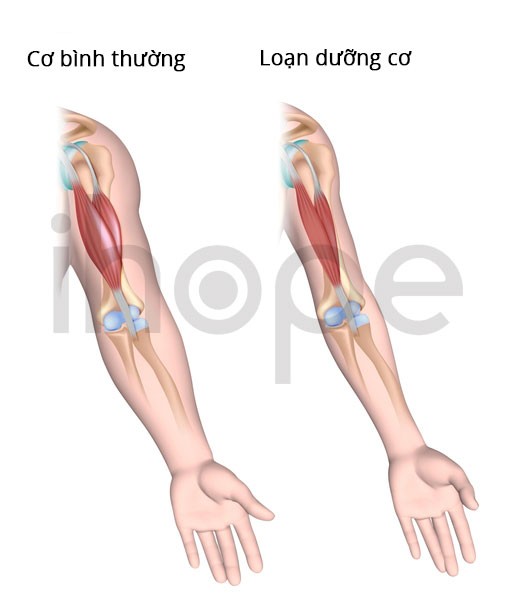 Trẻ mắc loạn dưỡng cơ Duchenne