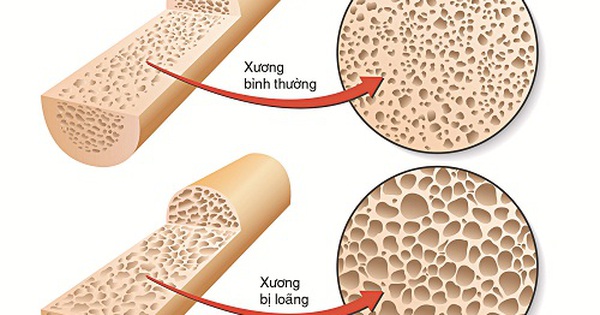 loãng xương do glucocorticoid