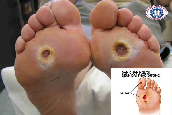 Biến chứng loét bàn chân tiểu đường