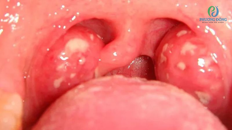 triệu chứng viêm loét họng