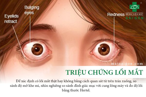 Biểu hiện lồi mắt rõ rệt