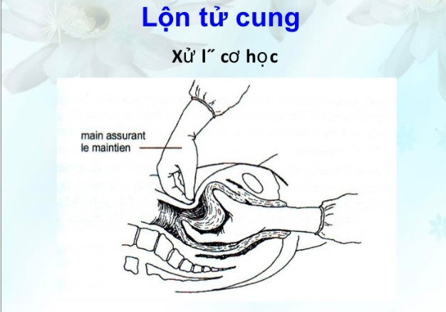Hình ảnh lộn tử cung