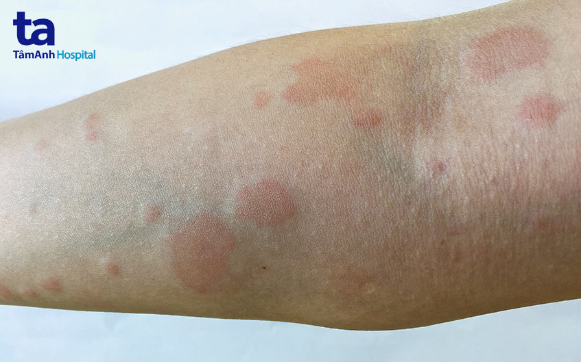 Hình ảnh triệu chứng lupus ban đỏ dạng đĩa