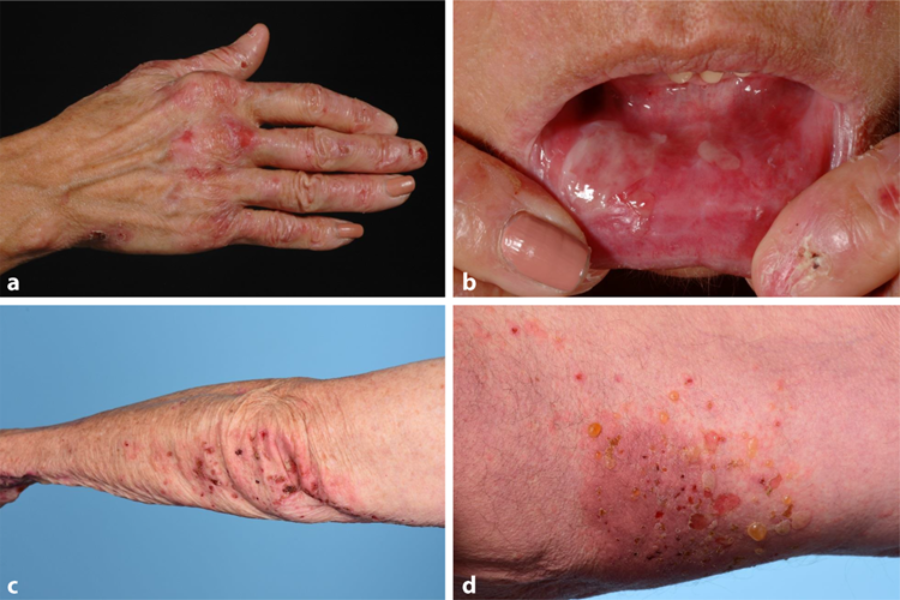 Triệu chứng ly thượng bì bọng nước