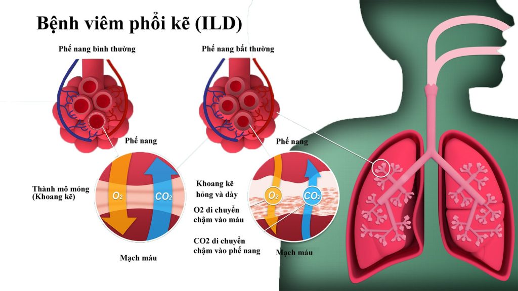 Hình ảnh mô phổi thâm nhiễm lympho