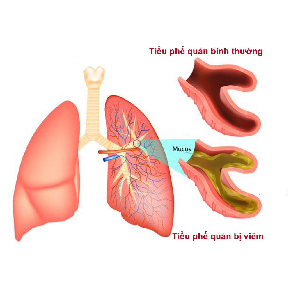 Viêm toàn tiểu phế quản lan tỏa: Nguyên nhân, triệu chứng và điều trị 8 Trẻ em điều trị viêm phế quản bằng khí dung