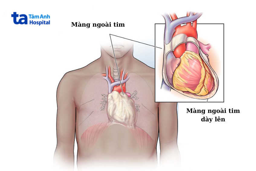 Viêm màng ngoài tim co thắt: Hiểu đúng để điều trị kịp thời 8 Hình ảnh màng ngoài tim dày và xơ hóa