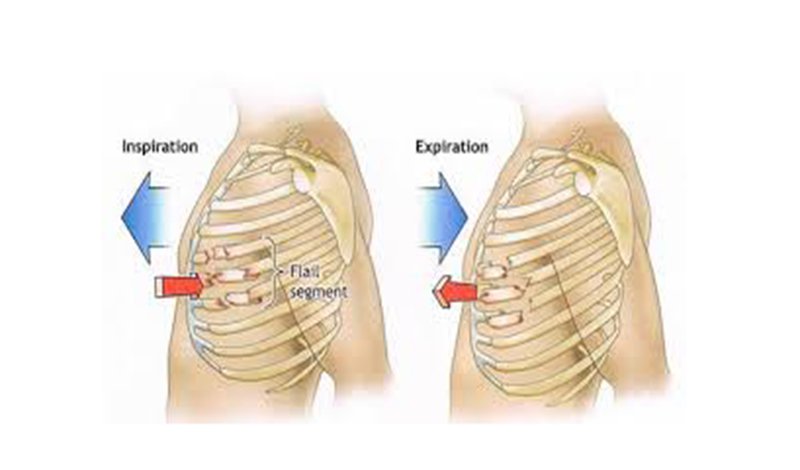 X-quang mảng sườn di động