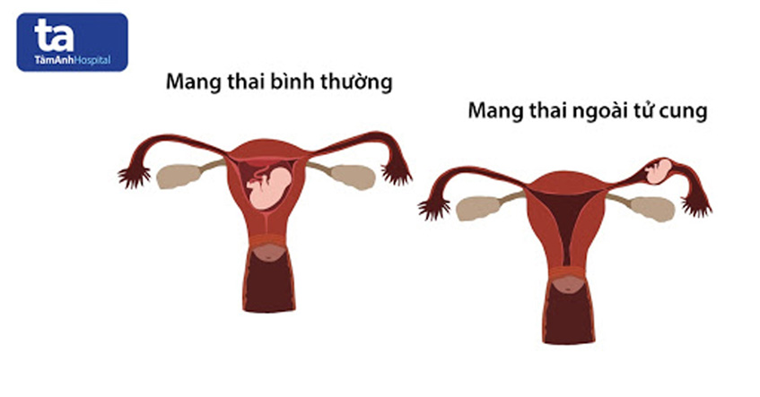 siêu âm thai ngoài tử cung
