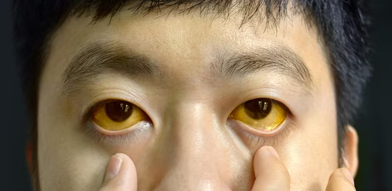 Mắt bị vàng ở người lớn