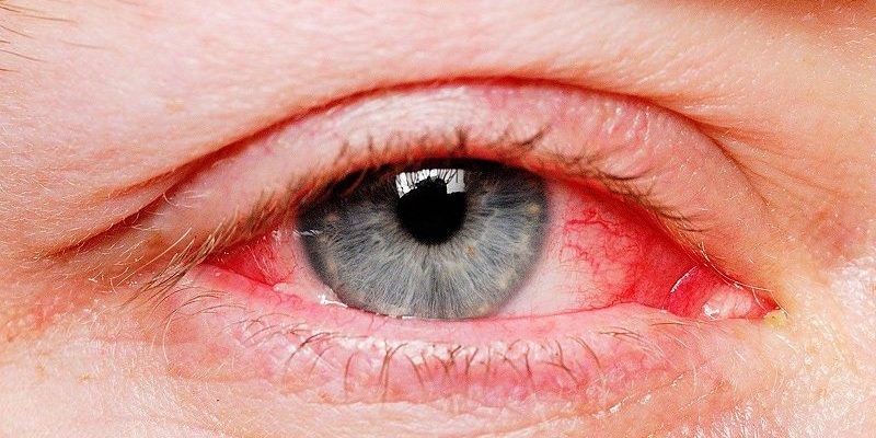 Mắt đỏ có mủ cần điều trị sớm
