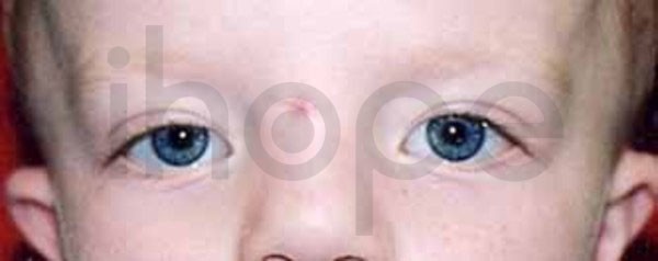 Khoảng cách hai mắt xa trong hội chứng Loeys-Dietz