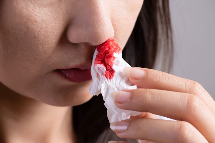 Cách xử lý chảy máu cam tại nhà