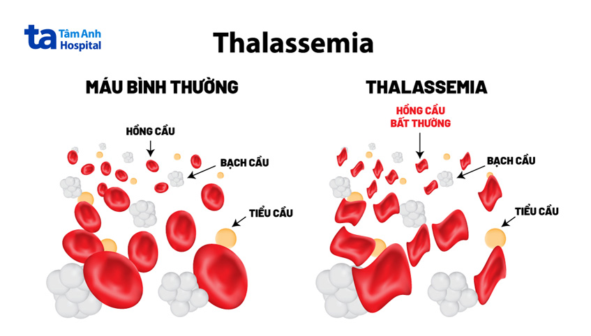 Hình ảnh máu người mang gen Thalassemia