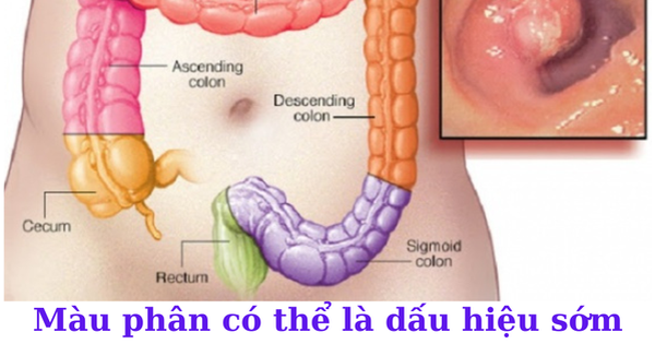 Thay đổi thói quen đại tiện: Khi nào là dấu hiệu bất thường? 7 Màu phân bất thường là dấu hiệu cảnh báo bệnh lý