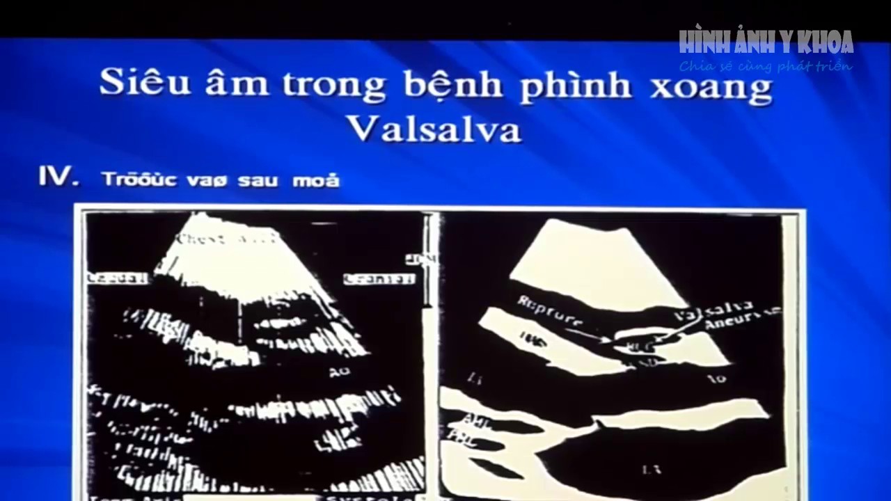 Phình xoang Valsalva vỡ