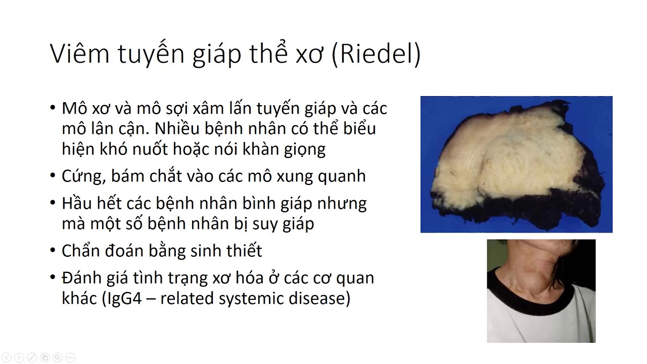 Viêm tuyến giáp xơ hóa Riedel