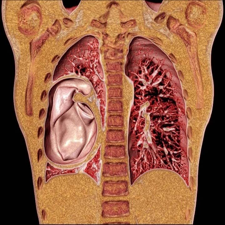Hình ảnh CT nang sán phổi