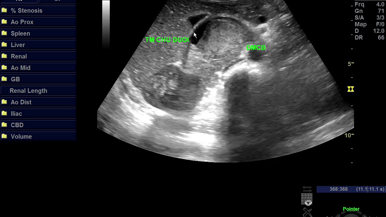 U nguyên bào thần kinh (Neuroblastoma): Ung thư nguy hiểm ở trẻ em không thể xem nhẹ 8 Bé gái chiến thắng u nguyên bào thần kinh