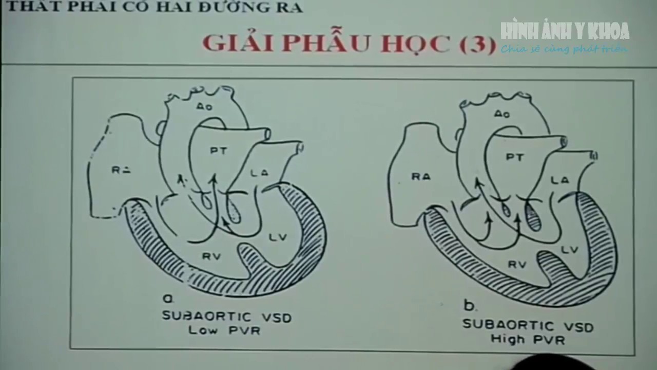 Siêu âm tim chẩn đoán DORV
