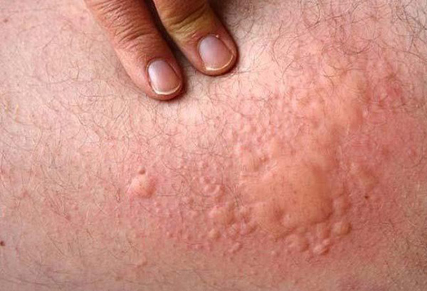 Mày Đay Cấp Tính: Nguyên Nhân, Triệu Chứng và Hướng Điều Trị Hiệu Quả 7 Triệu chứng mày đay cấp tính