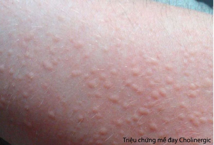 triệu chứng mày đay do nước