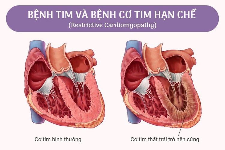hình ảnh cơ tim hạn chế