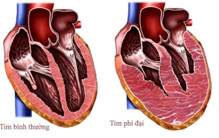 phì đại cơ tim do Fabry