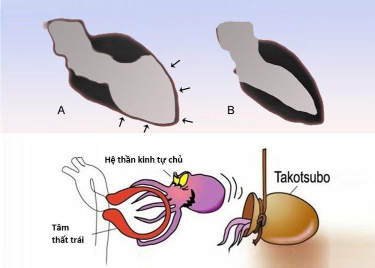 Hình ảnh minh họa triệu chứng Takotsubo