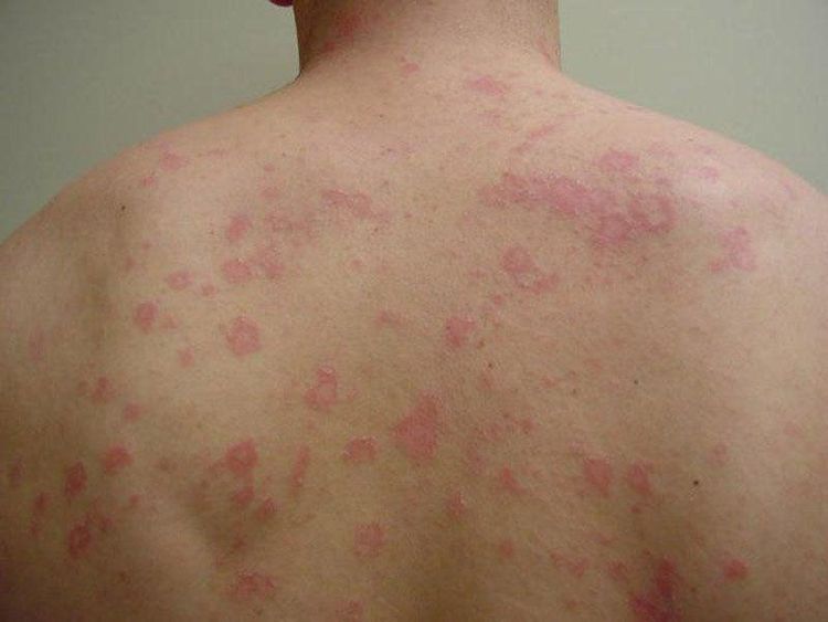 Tổn thương điển hình vảy phấn hồng Gibert