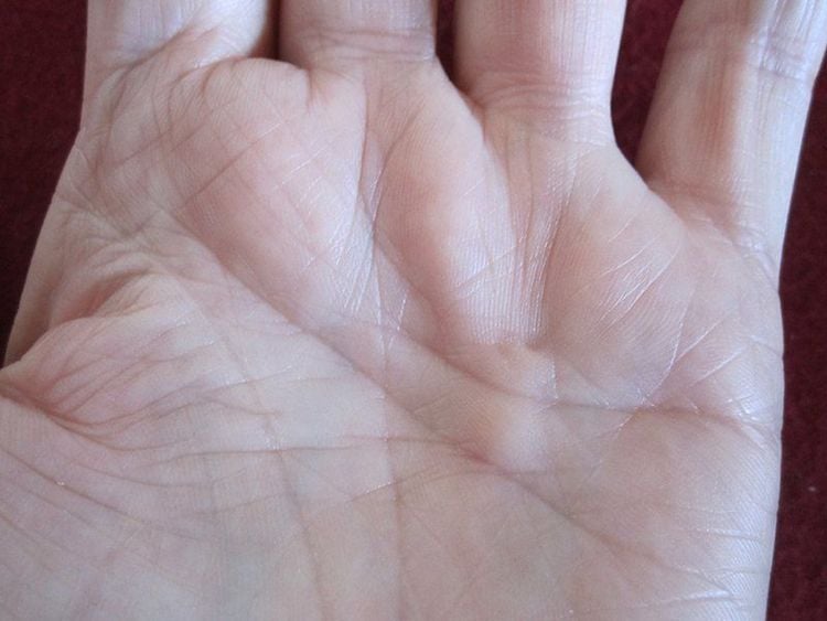 Giải phẫu lòng bàn tay và gân co cứng Dupuytren