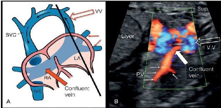 Bất thường tĩnh mạch phổi trở về hoàn toàn/bán phần: Dị tật tim hiếm gặp và những điều cần biết 7 Bất thường tĩnh mạch phổi