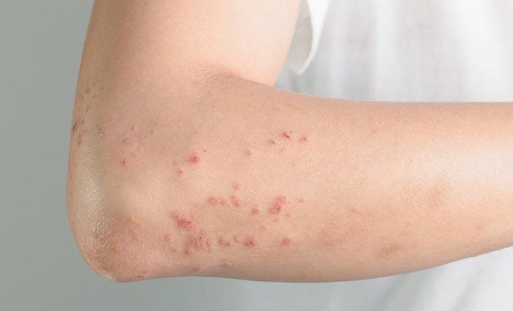 Triệu chứng dị ứng hạt cây